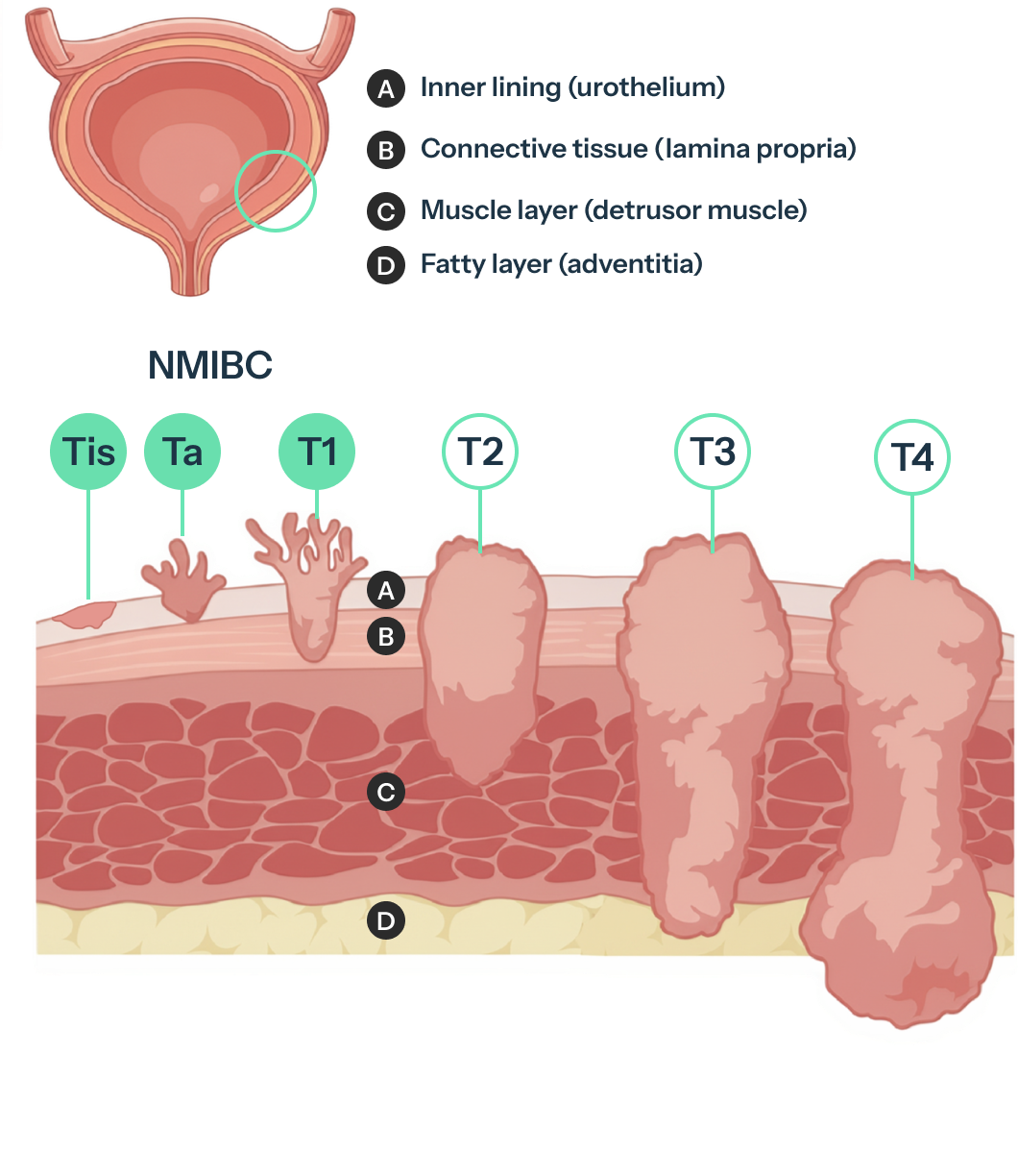 Diagram and text detailing bladder cancer stages: NMIBC (Stage 0, 1) and MIBC (Stage 2, 3, 4), with visual tumor representations.